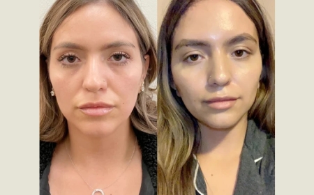 Thread Lift in Dubai for Under-Eye Rejuvenation: Does It Work?