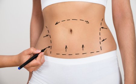 Transforming Bodies and Lifestyles After Liposuction Surgery in Dubai