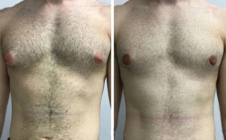 Non-Surgical Alternatives vs. Gynecomastia Surgery in Dubai: Which One Works?