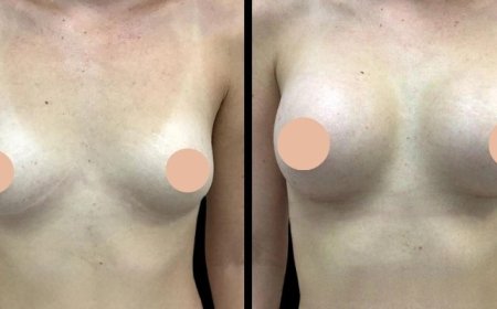 Breast Augmentation Surgery in Dubai: Ideal Candidates and Eligibility