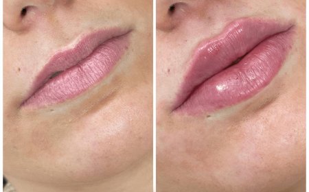 Best Plastic Surgeon in Dubai: How Often Should You Get Dermal Fillers?