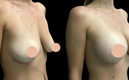 5 Signs You’ve Found the Best Breast Augmentation Surgeon in Dubai
