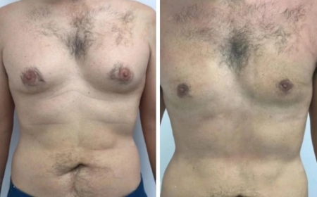 What Makes the Best Gynecomastia Surgeon in Dubai Special in Terms of Care