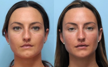 Choosing the Best Plastic Surgeon in Dubai for Thread Lift Rejuvenation