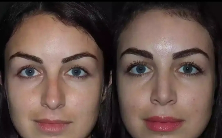 Best Rhinoplasty Surgeon in Dubai for Functional and Cosmetic Nose Surgery