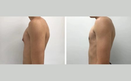 Recovery After Gynecomastia Surgery in Dubai