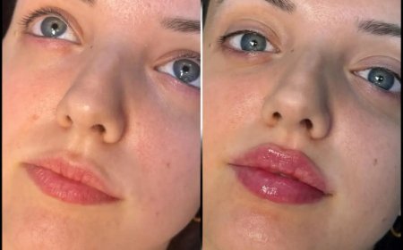 Customized Beauty: How Fillers in Dubai Are Tailored to Your Face