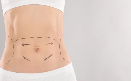 How 360 Liposuction in Dubai Can Transform Your Body Shape