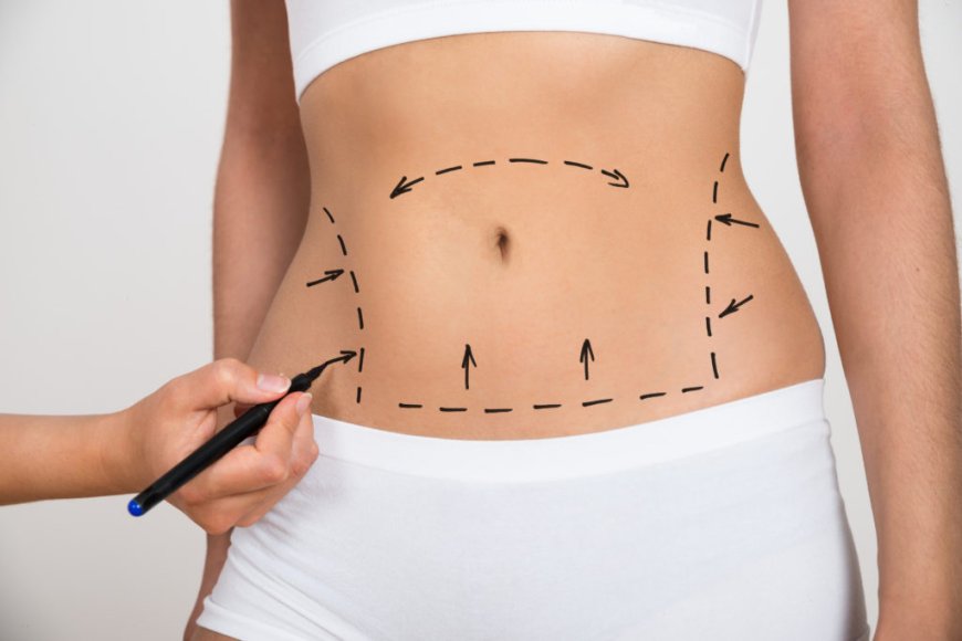 Transforming Bodies and Lifestyles After Liposuction Surgery in Dubai