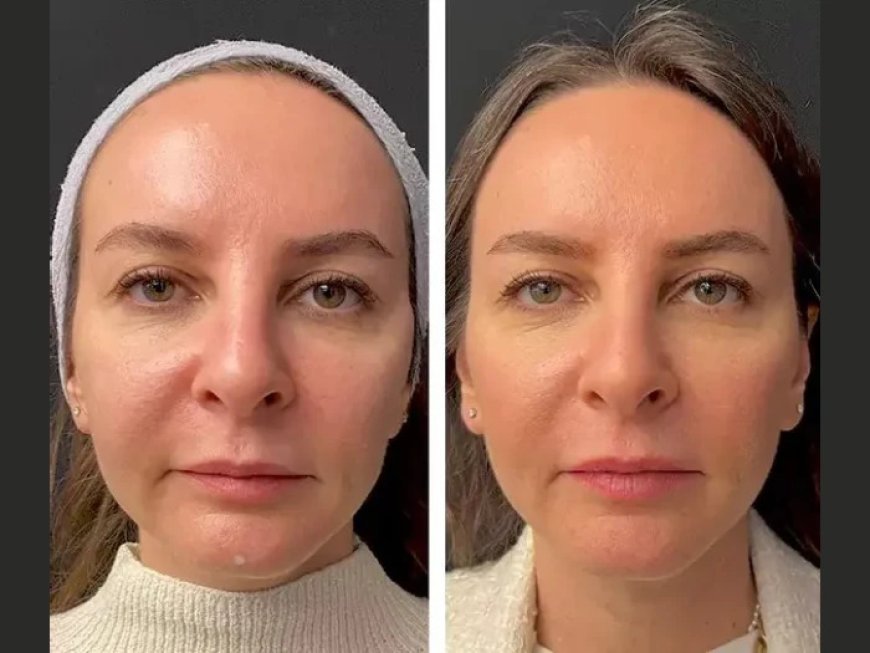 Mesotherapy for Double Chin Reduction by the Best Plastic Surgeons in Dubai