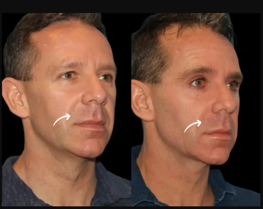 The Art of Injection: Why Sculptra Fillers Require the Best Plastic Surgeons in Dubai