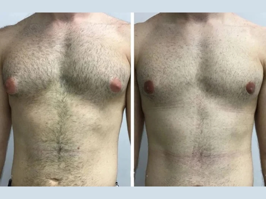 Non-Surgical Alternatives vs. Gynecomastia Surgery in Dubai: Which One Works?