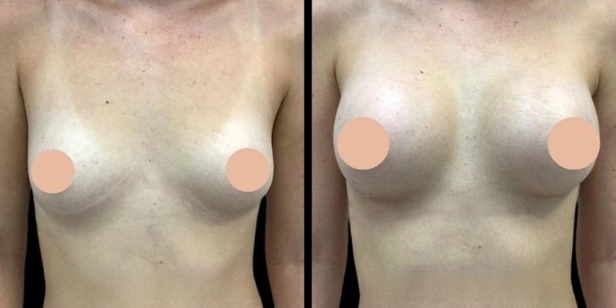 Breast Augmentation Surgery in Dubai: Ideal Candidates and Eligibility