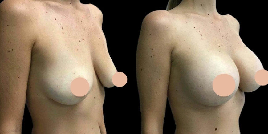 5 Signs You’ve Found the Best Breast Augmentation Surgeon in Dubai