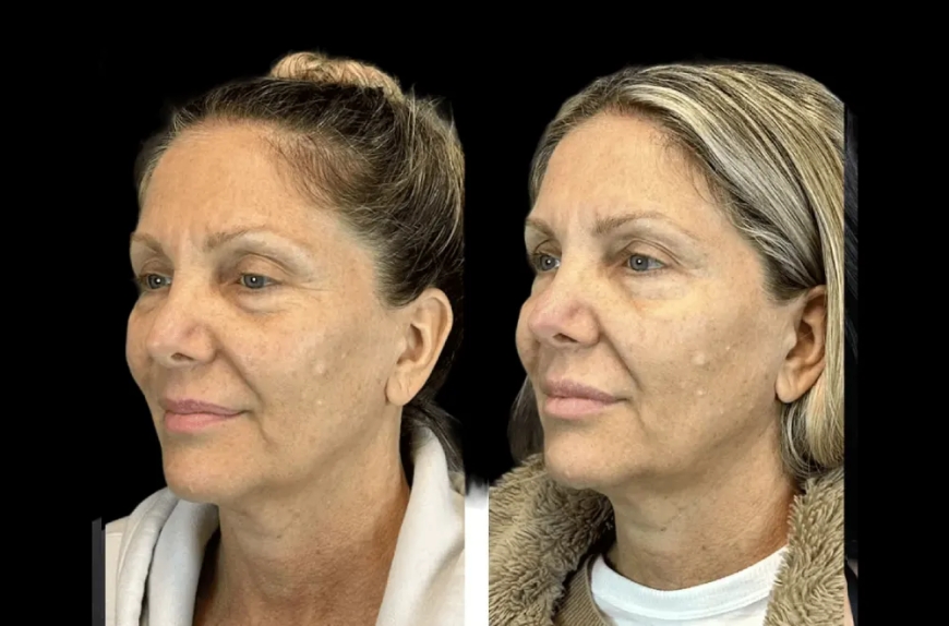 How the Best Plastic Surgeon in dubai Uses Botox for a Natural Look