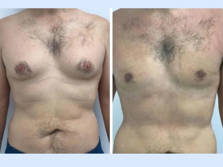 What Makes the Best Gynecomastia Surgeon in Dubai Special in Terms of Care