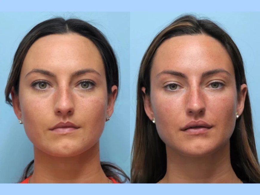 Choosing the Best Plastic Surgeon in Dubai for Thread Lift Rejuvenation