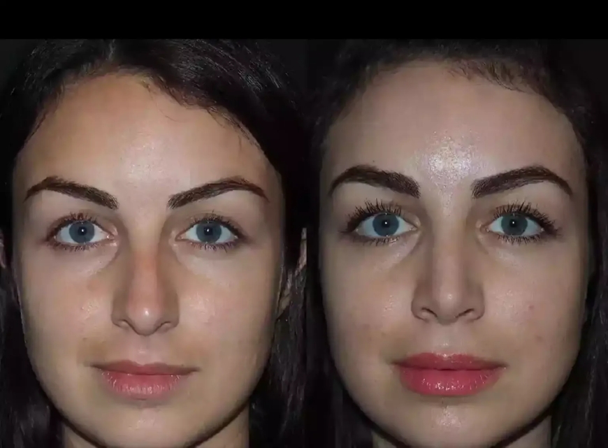 Best Rhinoplasty Surgeon in Dubai for Functional and Cosmetic Nose Surgery