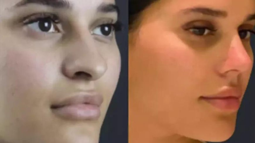 How the Best Septoplasty Surgeon in Dubai Improves Quality of Life