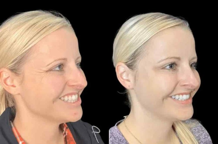 Secrets to Flawless Results from the Best Plastic Surgeon in Dubai for Botox