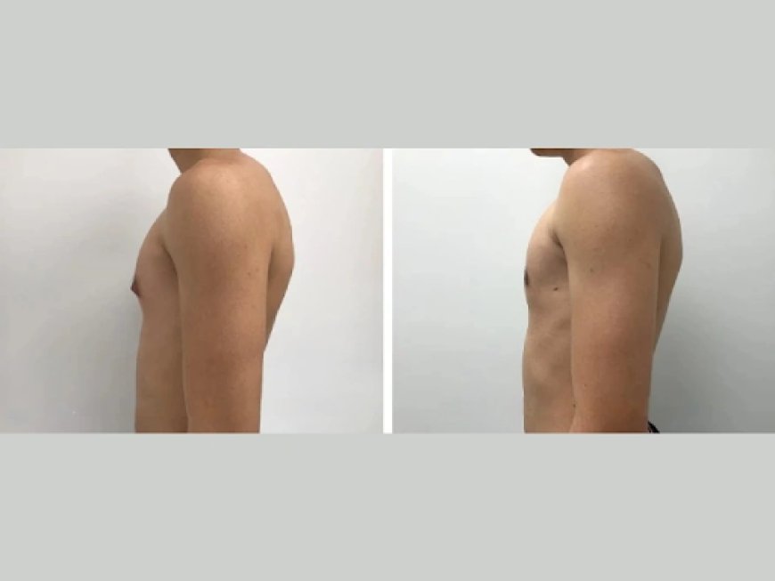 Behind the Credentials: What Sets Dubai's Best Gynecomastia Surgeons Apart