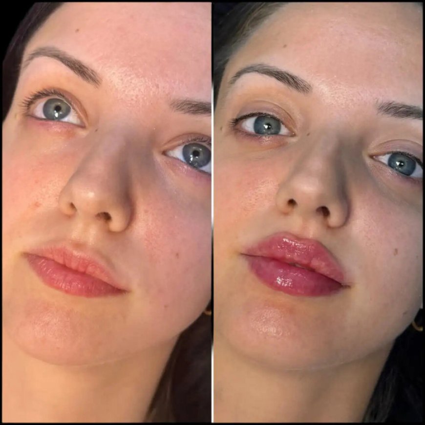 Achieve Fuller Cheeks with Fillers Treatment in Dubai