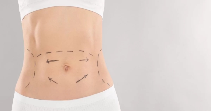 How 360 Liposuction in Dubai Can Transform Your Body Shape