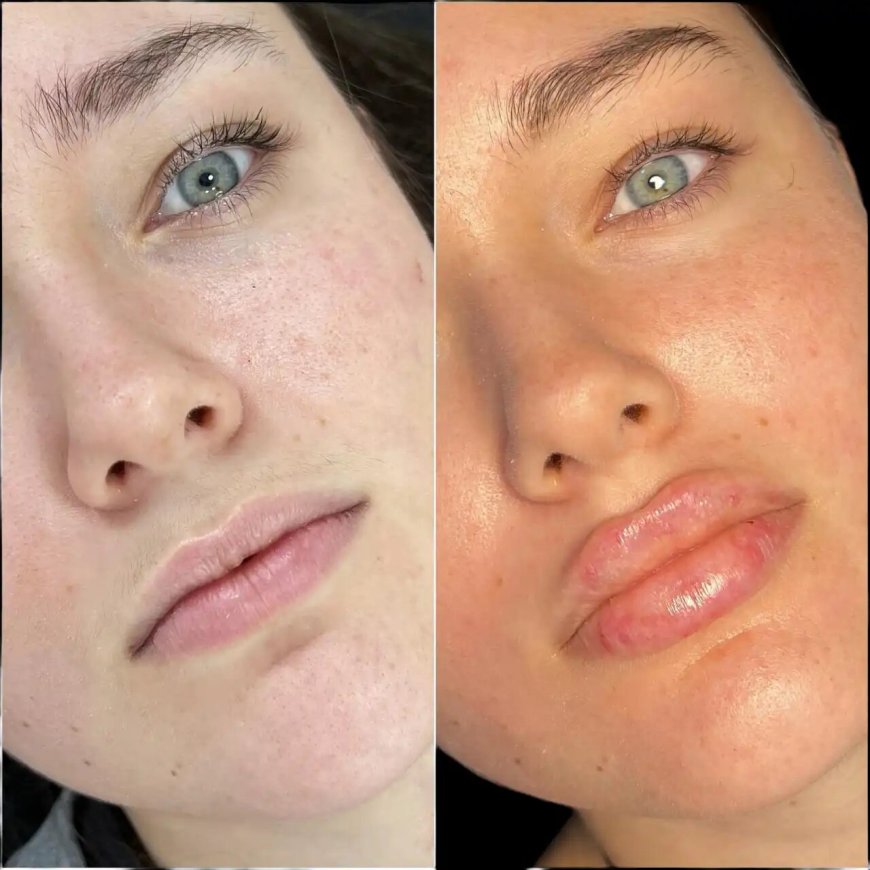 Fillers in Dubai by the Best Doctors in dubai: Quick Results, Youthful Appearance