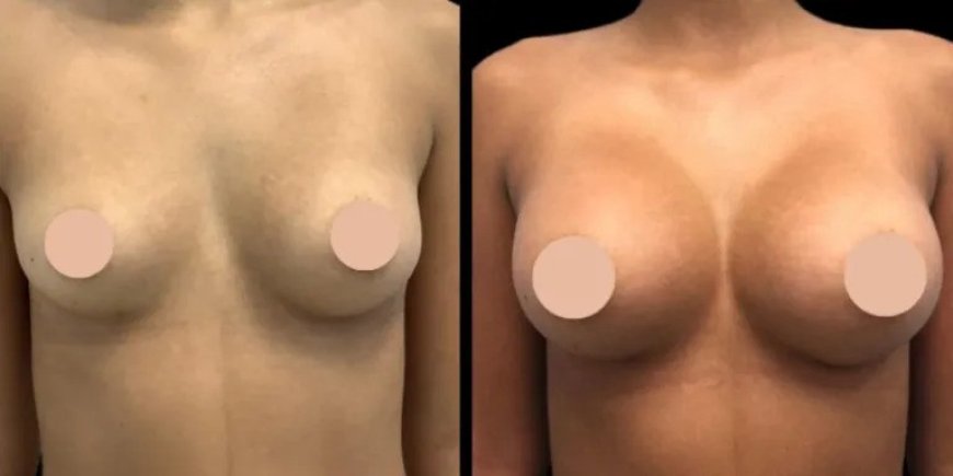 Breast Augmentation in Dubai: What to Expect Before, During, and After the Procedure