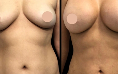 Natural Results with the Best Breast Augmentation Surgeon in Dubai