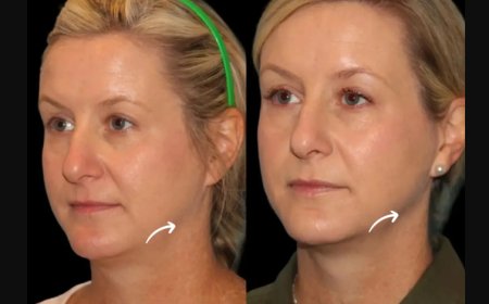 Sculptra Fillers for Athletes & Fitness Enthusiasts: Dubai Best Plastic Surgeons Share Tips