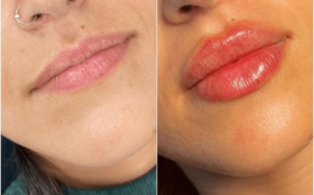 Is Juvederm Safe for All Skin Types? Expert Advice from the Best Plastic Surgeons in Dubai