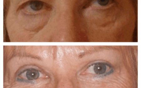 Eye bag removal in Dubai: Top FAQs answered