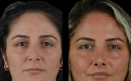 Why Cheek Fillers Treatments in Dubai Are Ideal for Busy Professionals