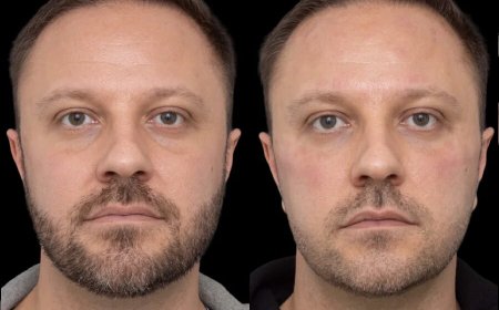 Get Brighter, More Refreshed Eyes with Under Eye Fillers Treatments in Dubai