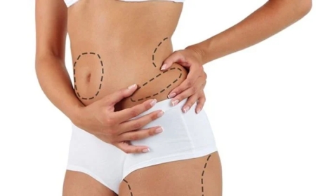 Is a Tummy Tuck in Dubai Right for You? Factors to Consider Before Surgery