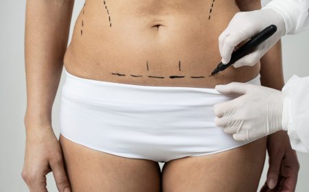 Tummy Tuck for Moms: Is the “Mommy Makeover” Right for You?