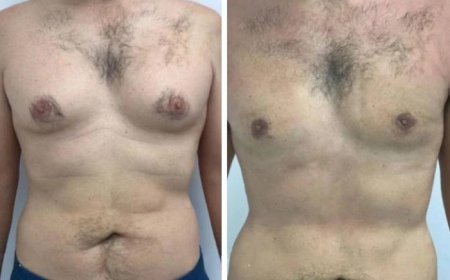 When Is the Right Time to have Gynecomastia in Dubai Surgery?