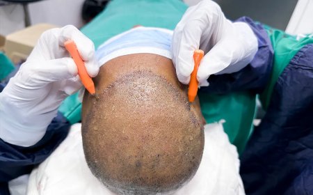 Will Hair Transplant Work on Curly or Afro Hair Types?