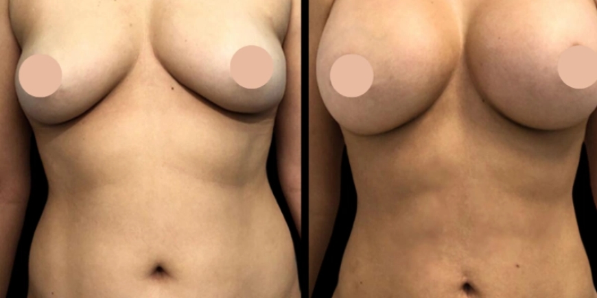 Natural Results with the Best Breast Augmentation Surgeon in Dubai