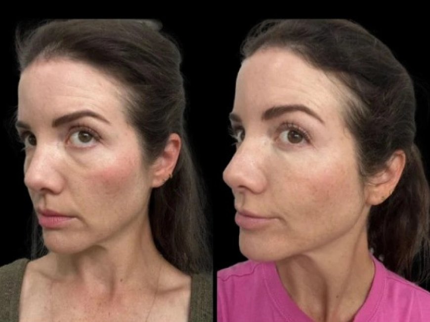 Dark Circles Treatment in Dubai: A Guide to Choosing Between Fillers and PRP Therapy