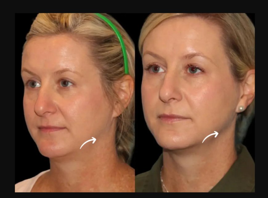 Sculptra Fillers for Athletes & Fitness Enthusiasts: Dubai Best Plastic Surgeons Share Tips