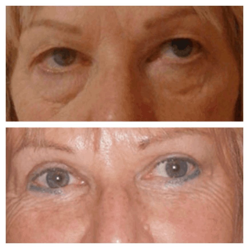 Eye bag removal in Dubai: Top FAQs answered