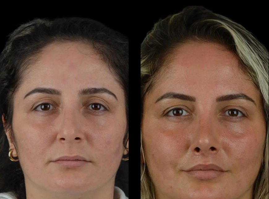Why Cheek Fillers Treatments in Dubai Are Ideal for Busy Professionals