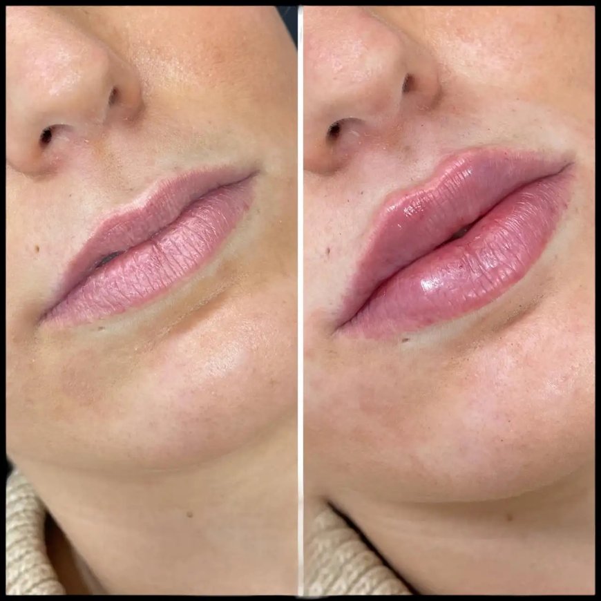 The Process of Russian Lip Fillers Treatments in Dubai Explained
