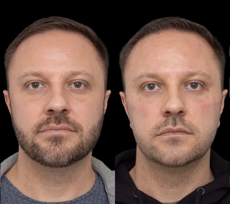 Get Brighter, More Refreshed Eyes with Under Eye Fillers Treatments in Dubai