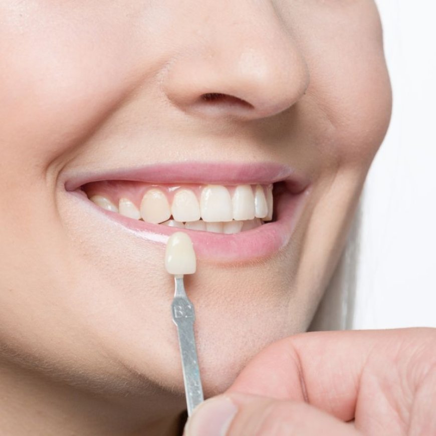 Can Dental Veneers Help with Uneven Tooth Lengths?