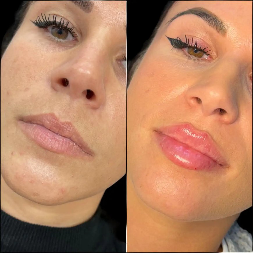 Best Doctors in Dubai for Natural-Looking Dermal Fillers Results