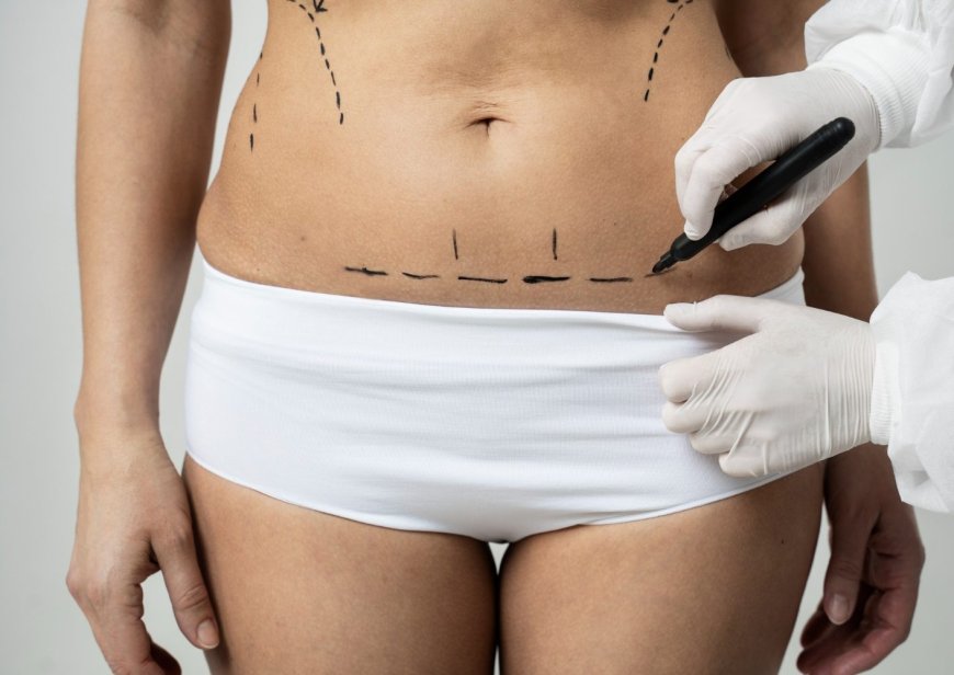 Tummy Tuck for Moms: Is the “Mommy Makeover” Right for You?