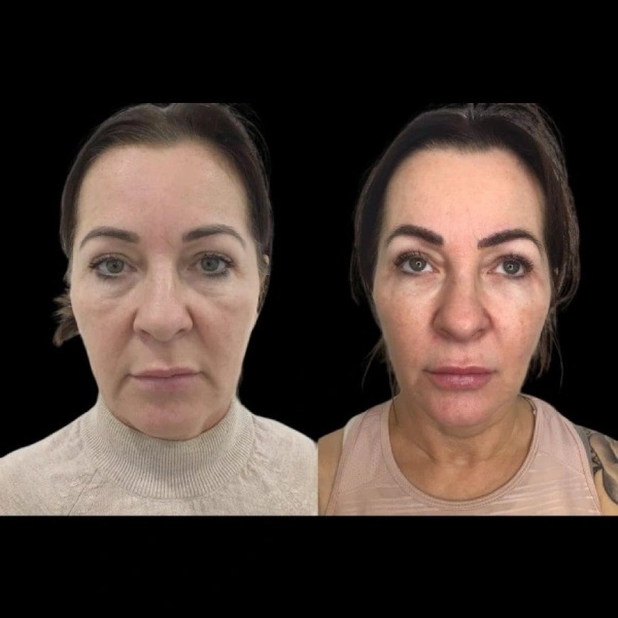 How the Best Aesthetic Clinic in Dubai Combines Profhilo with Other Skin Treatments